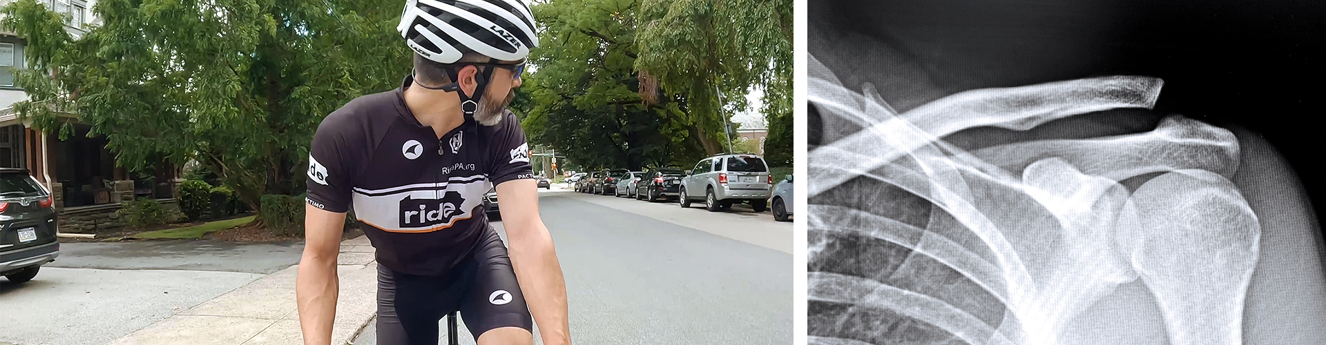 Riding with a separated shoulder. Injury timeline, recovery and training process